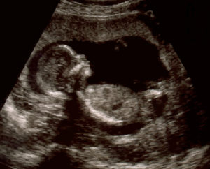 fetal ultrasound 300x242